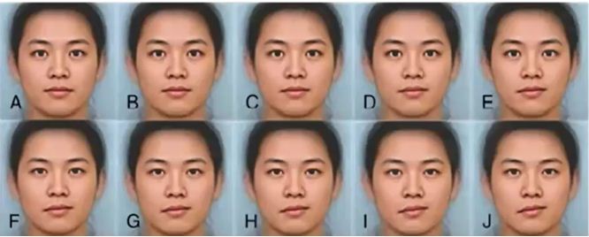 Bệnh nhân lệch mặt với đường môi lệch từ 0 đến 9 độ (từ A đến J)